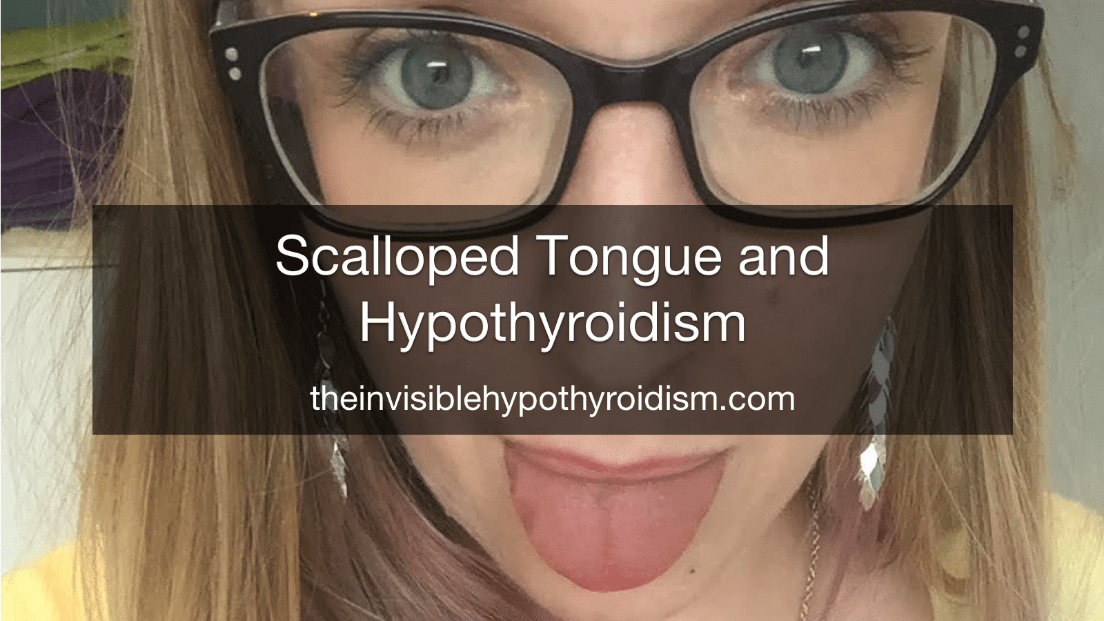 Scalloped Tongue and Hypothyroidism