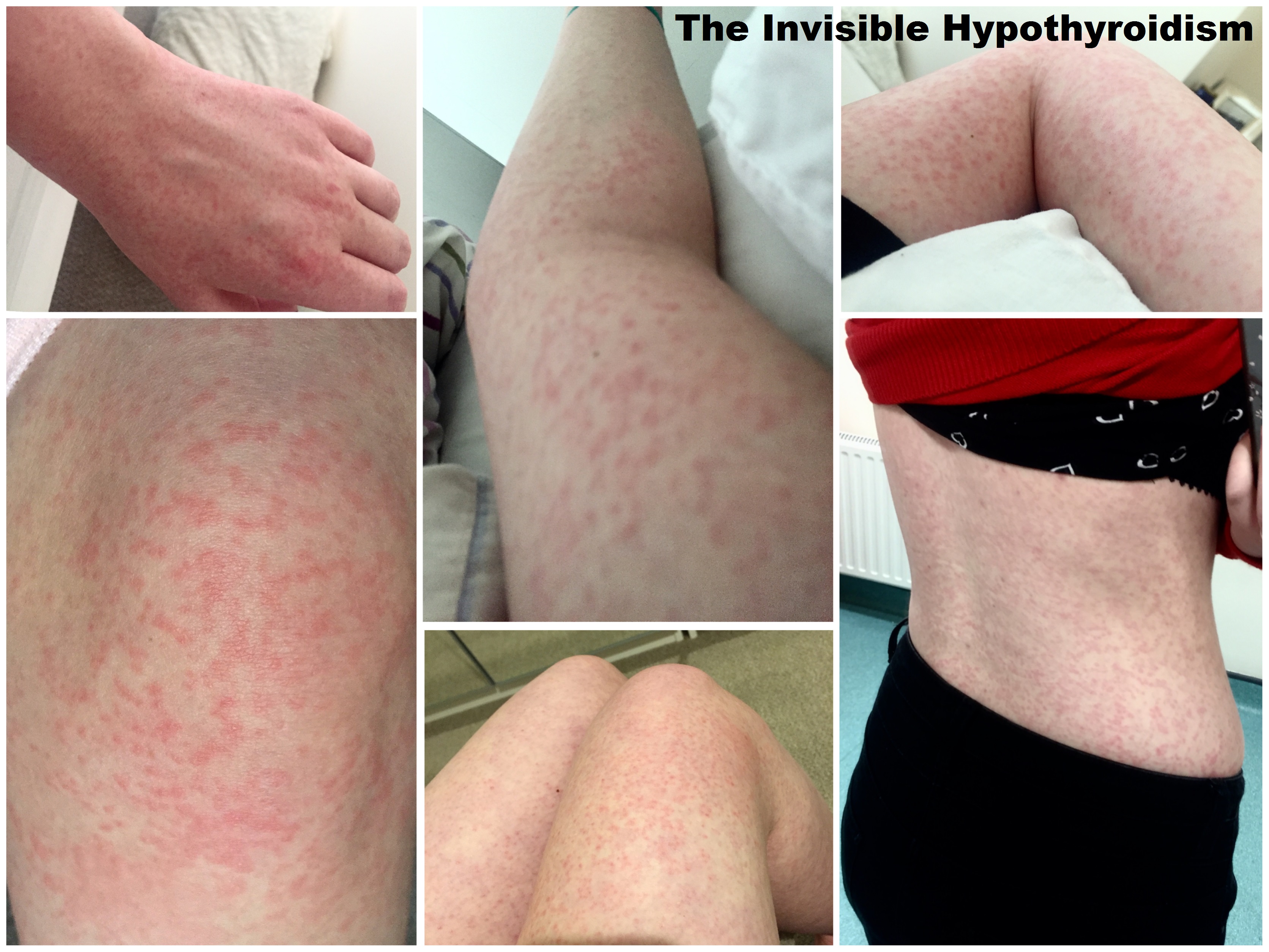 A collage of photos showing a severe allergic reaction across all of Rachel's body