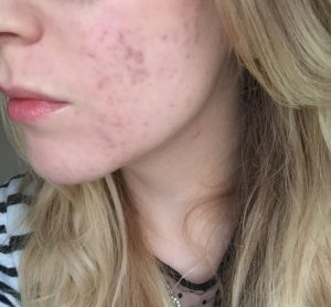 Un sefie ravvicinato di Rachel che mostra che la sua acne è guarita