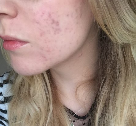 A close up sefie of Rachel showing her acne has cleared up