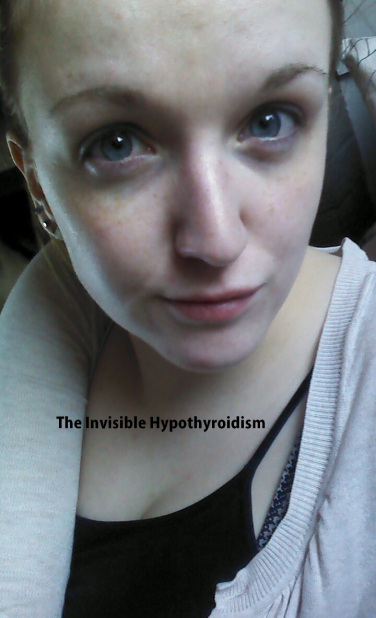 hypothyroidism before and after face