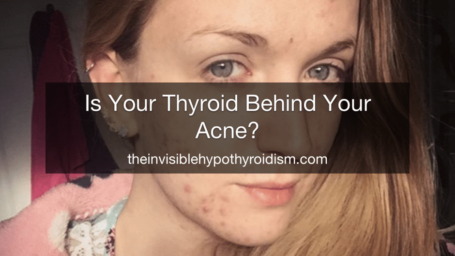 Is Your Thyroid Behind Your Acne?