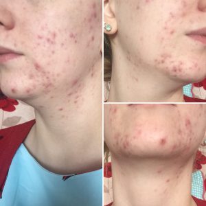 A 'Before' collage of photos showing different angles of Rachel's face showing acne all over.