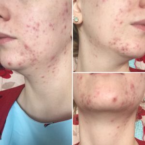 Un collage di foto del 'Prima' che mostra diverse angolazioni del viso di Rachel che mostrano acne dappertutto.'Before' collage of photos showing different angles of Rachel's face showing acne all over.