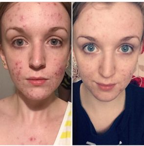 Una foto laterale del viso di Rachel che mostra molta acne a sinistra e un viso molto più chiaro a destra.'s face showing lots of acne on the left and a far clearer face on the right.