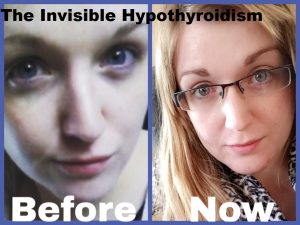 Before and After NDT Thyroid