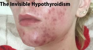 Thyroid Acne