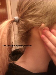 Hypothyroidism and Hair Loss