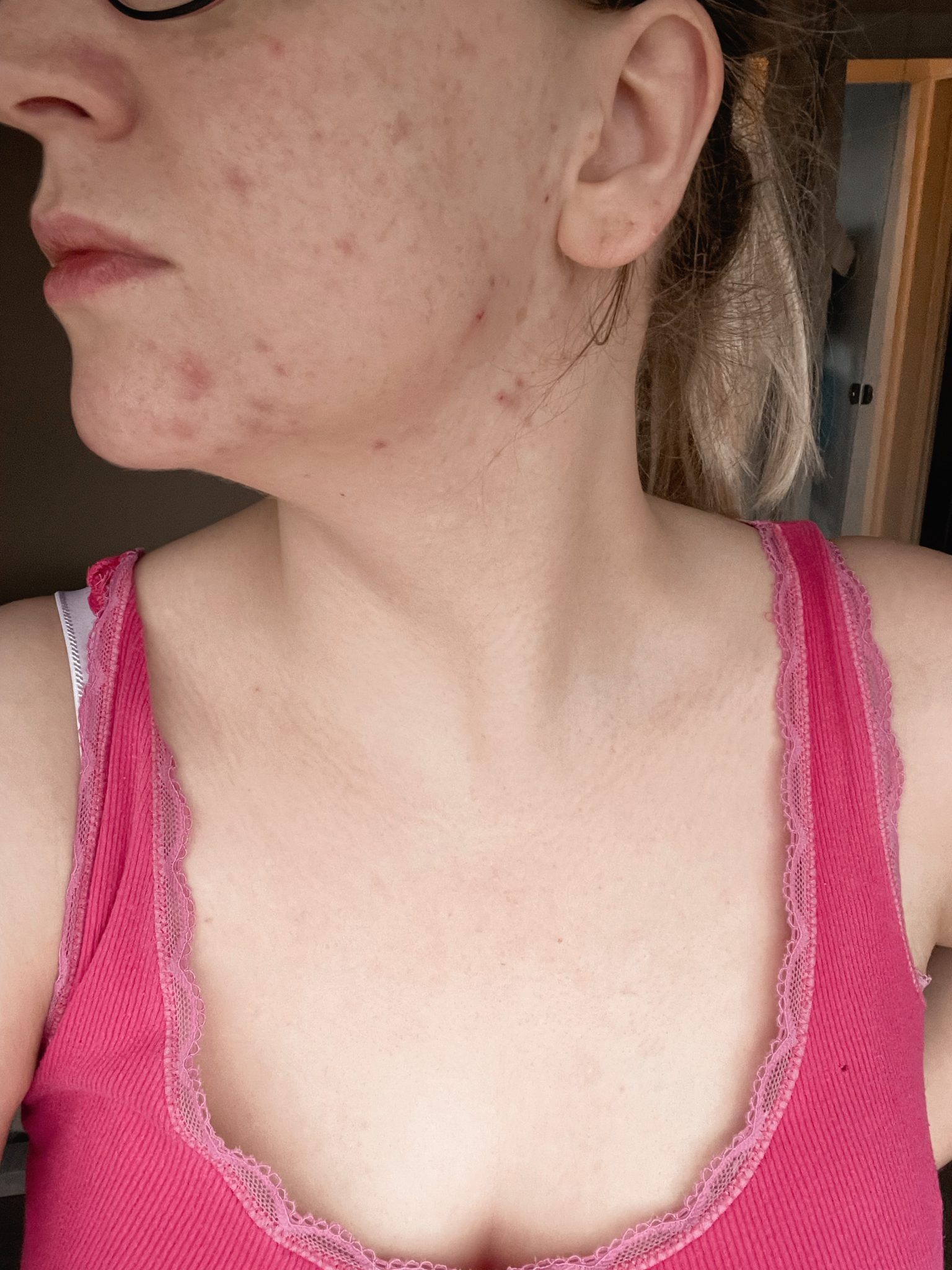 Is Your Thyroid Behind Your Acne?