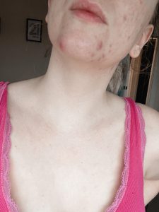 Thyroid and Acne