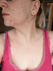 Thyroid and Acne