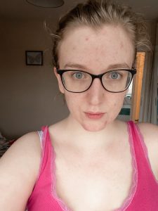 Thyroid and Acne