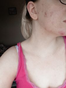 Thyroid and Acne