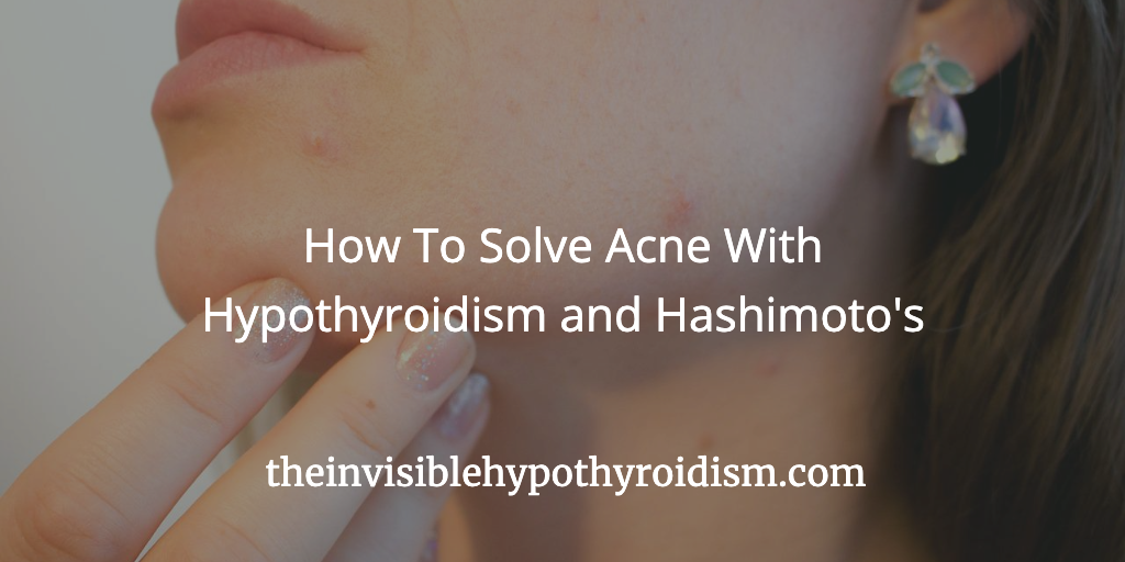 How To Solve Acne With Hypothyroidism and Hashimoto's